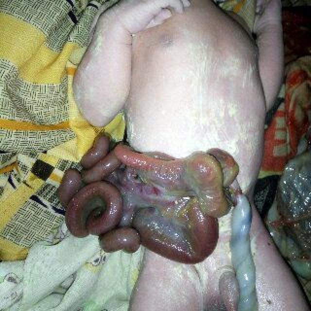 Bayi Asal Desa Belantaraya, Inhil Riau Lahir dengan Usus di Luar