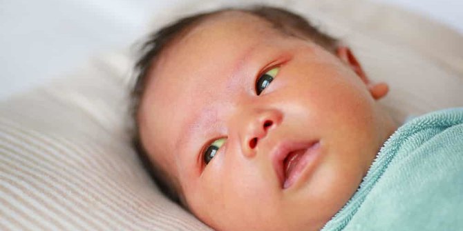Waspadai Ciri-ciri Gejala Penyakit Kuning Pada Anak yang Perlu Dikenali