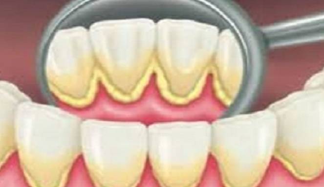 Cara Cepat Hilangkan Plak Gigi di Rumah dengan Cara Mudah Ini