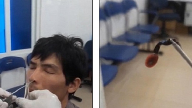 Dokter Keluarkan Lintah yang Menggeliat dari Hidung Pria