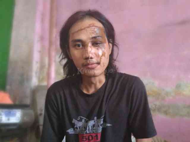 Penyiram Air Keras Ngaku Jatuh, Ditanya Keluarga Soal Luka di Wajah