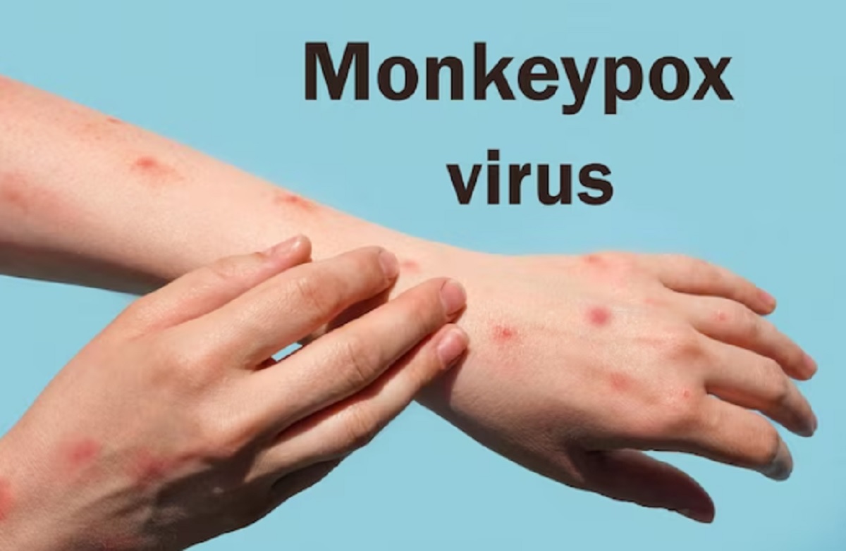 Ini Alasan Kenapa Kasus Cacar Monyet Lebih Banyak Muncul di DKI Jakarta,