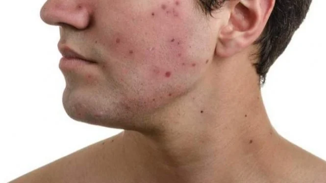 6 Jenis Jerawat Beserta Penyebab dan Cara Mengobatinya