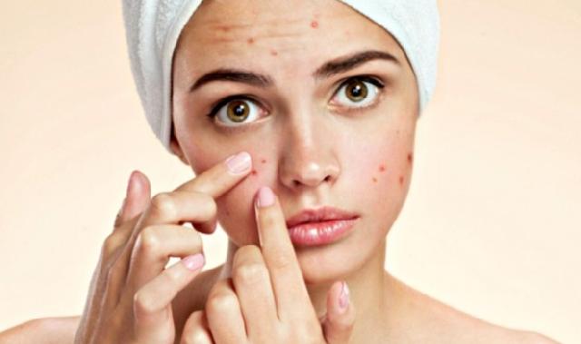 Deteksi penyakit yang mengintai dari letak tumbuhnya jerawat