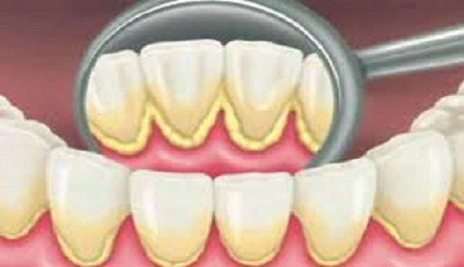 5 Resep Hilangkan Plak, Terakhir Mudah Sekali Dilakukan
