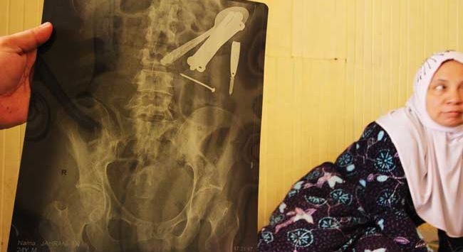 Seram ! Ini Pengakuan Jahrani yang Perutnya Bersarang Benda Aneh