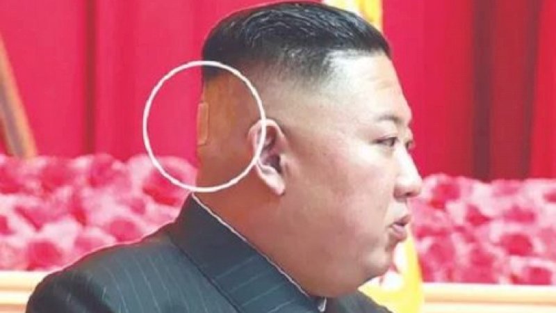 Ada Bintik di Kepala dan Pakai Perban, Ada Apa dengan Kim Jong-un?