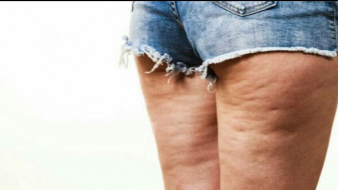 Cara Melenyapkan Selulit dalam 13 Hari dengan Bawang Putih