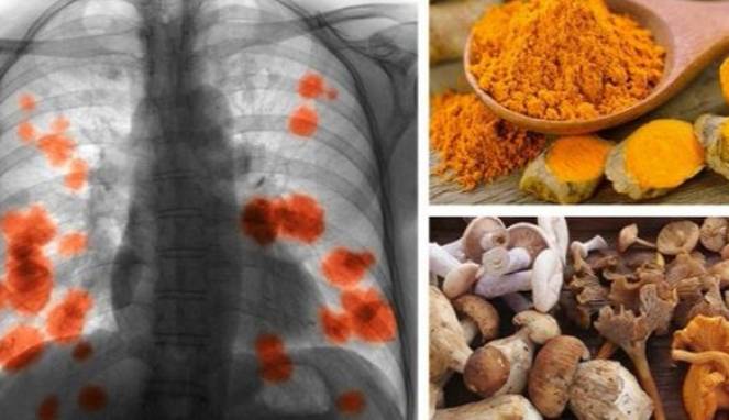 5 Makanan Ini Bisa Hentikan Penyebaran Kanker Paru-paru