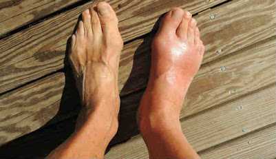 Enam Pengobatan Asam Urat Alami dalam 24 Jam Langsung Sembuh