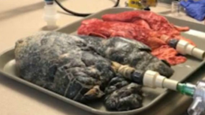 Viral Video Mengejutkan Perbedaan Paru-paru Sehat dan Perokok