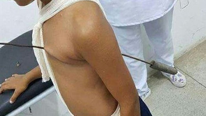 Wow, Jantung Bocah Ini Tertembus Besi Tapi Tetap Selamat
