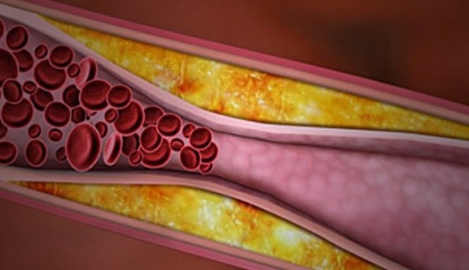 5 Gejala Anda Terkena Penyakit Kolesterol Tinggi