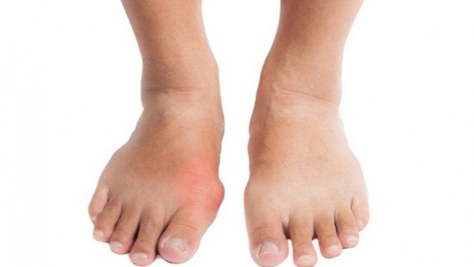 5 Penyakit Berbahaya Ini Muncul Akibat Asam Urat