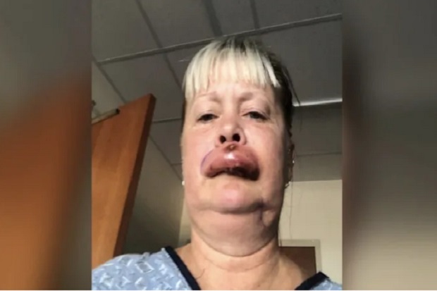 Wanita Ini Mengalami Halusinasi Usai Bibirnya Jontor Digigit Laba-Laba Berbisa