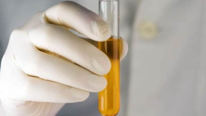 Waspada! 4 Penyakit Ini Picu Perubahan Warna Urine