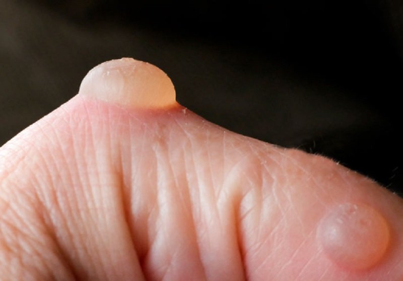 Ingat! Bukan Pakai Pasta Gigi atau Kecap, Ini Pertolongan Pertama saat Kulit Melepuh