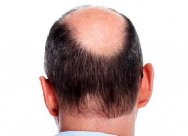 Pria Botak Berisiko Alami Dampak Lebih Fatal saat Terinfeksi Covid-19