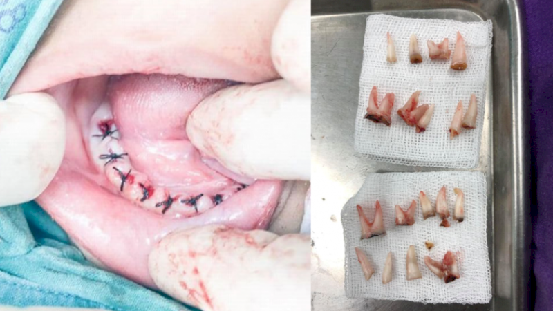 Duh! Gigi Bocah 4 Tahun Membusuk Akibat Kebiasaan Tidur dengan Botol Susu di Mulut