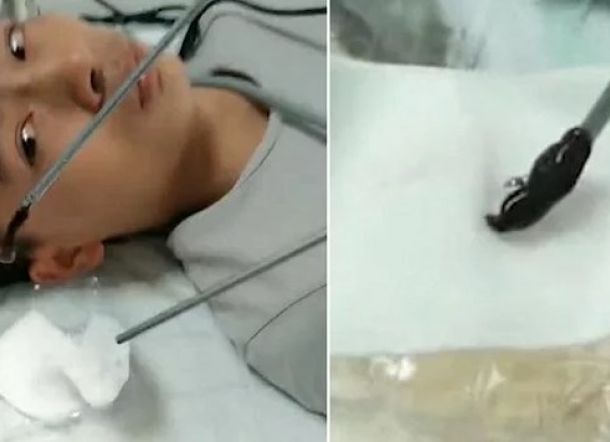 Pria ini Tidak Sadar Ada Lintah Bersarang di Hidungnya Selama 3 Bulan