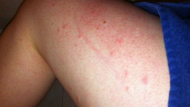 Awal 6 Gejala HIV yang Sering Diabaikan