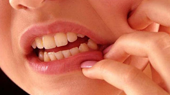 Redakan Sakit Gigi karena Berlubang, Begini Caranya