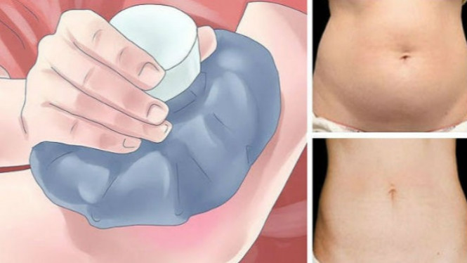 Coba hilangkan Lemak di Tubuh dengan Teknik Pembekuan