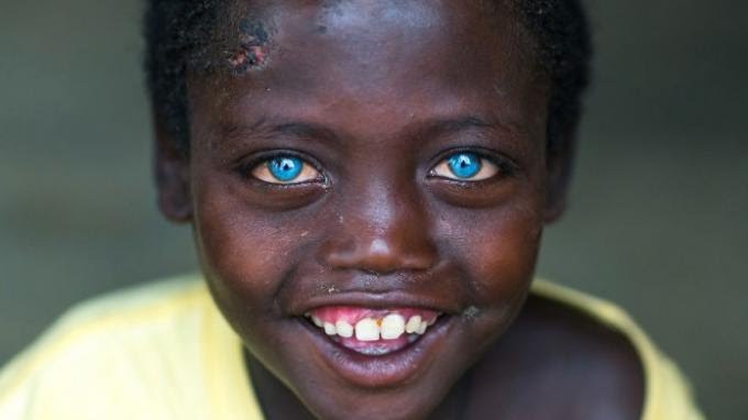 Mata Biru Bocah 8 Tahun Penderita Sindrom Waardenburg Buat Banyak Orang Terpesona