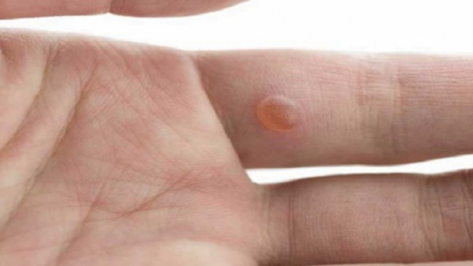 Gejala-gejala Awal Kanker Paru-paru yang Harus Diperhatikan