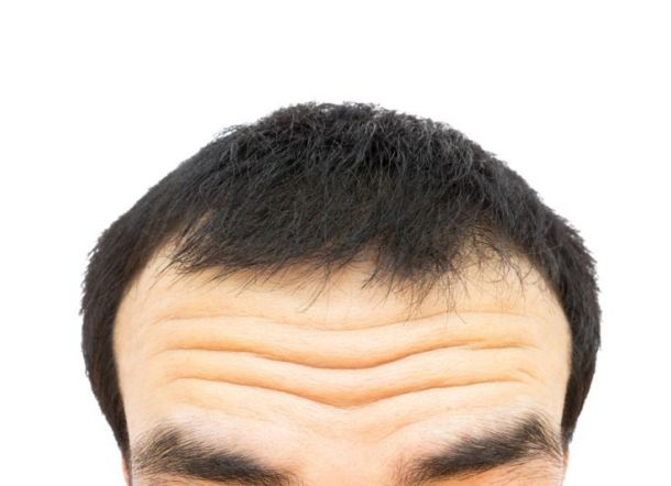 Keriput di Dahi Mungkin Pertanda Anda Memiliki Penyakit Ini!