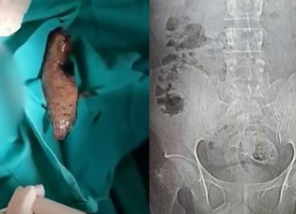 Perawat Muntah-muntah saat Mengeluarkan Ikan Nila di Perut Pria Ini