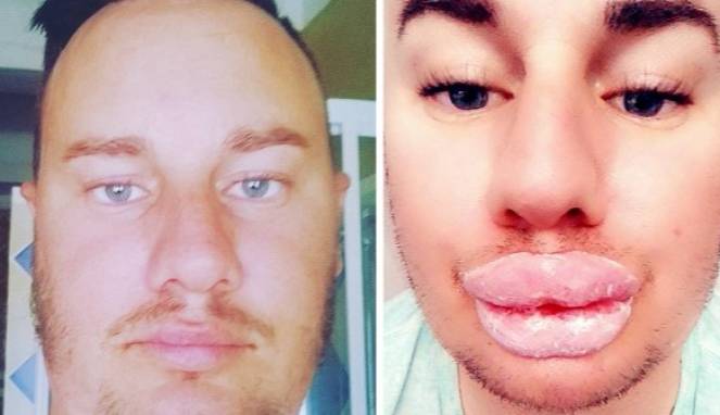 Ingin Mirip Marilyn Monroe, Lihat Perubahan Bibir Pria Ini