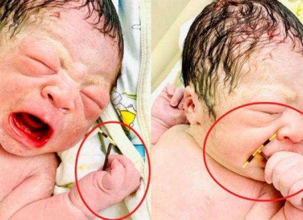 Bayi Ini Lahir dengan Menggenggam Alat Kontrasepsi