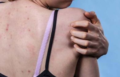 Jerawat di Punggung, Bahaya Gak Sih? Ini Penjelasannya