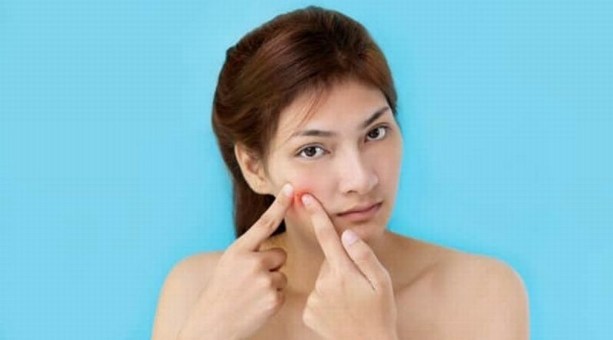 Berikut 3 Bahan Alami untuk Hilangkan Bintik Hitam Bekas Jerawat