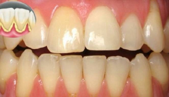 Gak Perlu ke Dokter Gigi untuk Hilangkan Plak Membandel