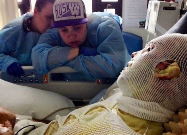 Tubuhnya Terbakar dari Dalam, Kulit Pria Ini Terpaksa Dibalut Kulit Babi