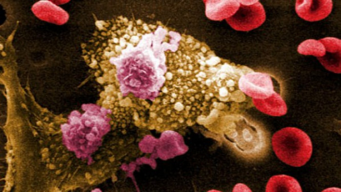 10 Cara Mencegah Kanker Kulit, Nomor 4 Penting