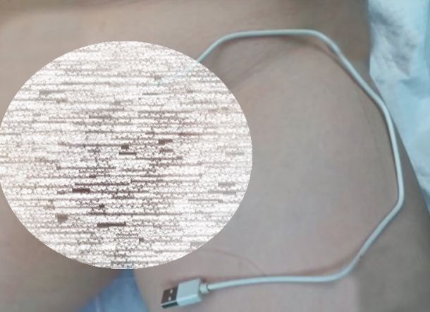 Penasaran, Bocah ini Masukkan Kabel USB ke Penisnya, Ini yang Terjadi Selanjutnya