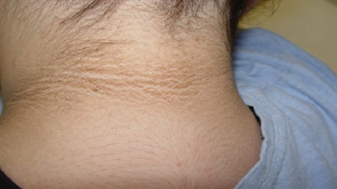 Tips Hilangkan Leher Hitam dengan Dua Bahan di Dapur