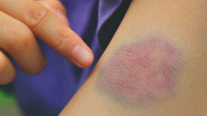 Enam Tanda Anda Mengalami Pembekuan Darah