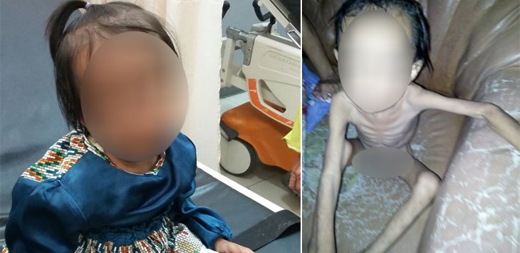 Disangka Gizi Buruk, Ternyata Bocah Ini Tertular HIV AIDS, Ayah dan Ibunya Sudah Meninggal