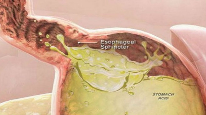 Ini Jenis Kanker yang Sangat Cepat Berkembang