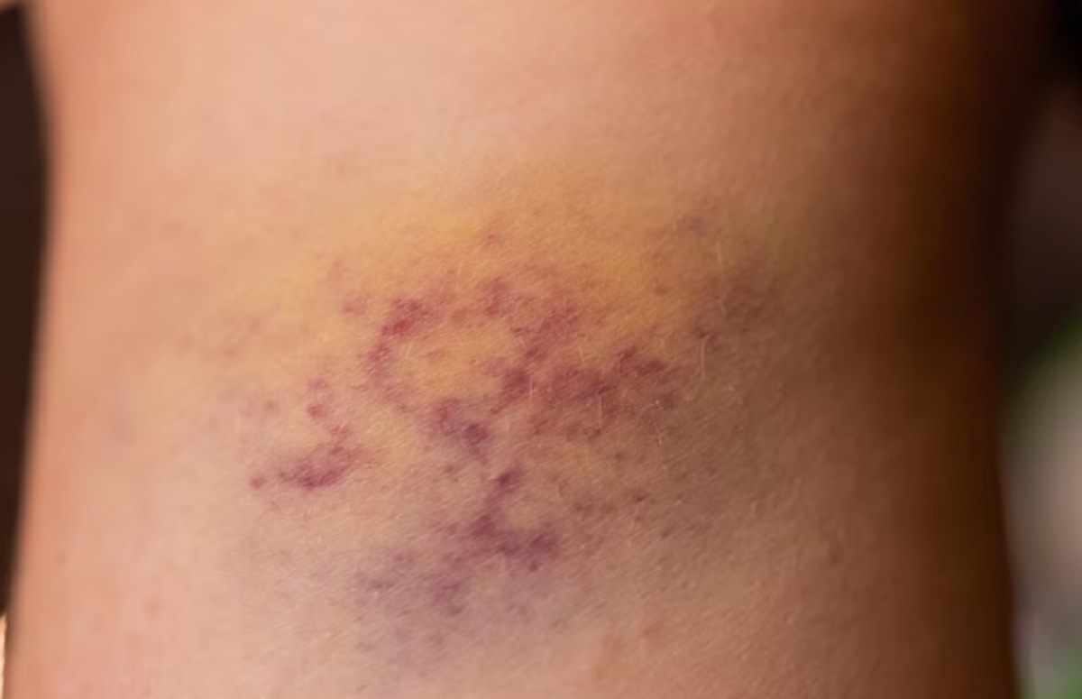 Lebam Mendadak Disebabkan Dijilat Setan, Mitos atau Fakta?