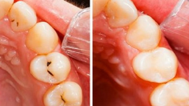 Cara Ampuh Menghilangkan Karang Gigi Tanpa Pergi ke Dokter