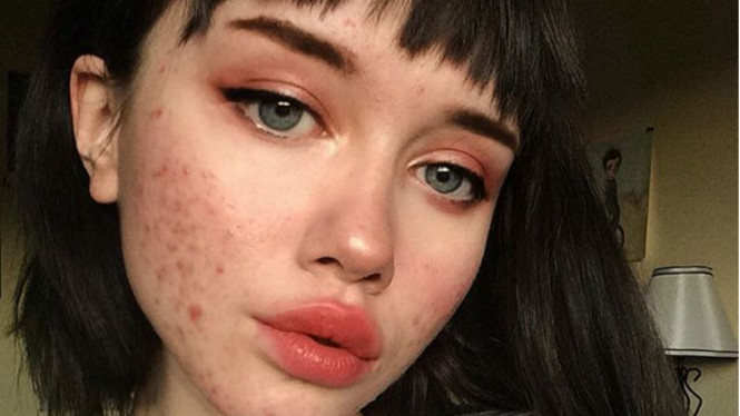 Bahayanya Jerawat Selalu Muncul di Tempat yang Sama