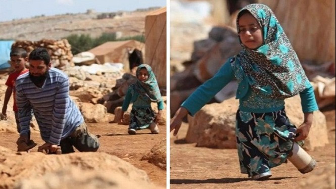 Kisah Sedih Gadis Kecil Suriah Berkaki Kaleng Sarden