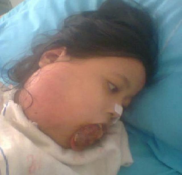 Bocah 9 Tahun Asal Bengkalis Ini Berjuang Melawan Kanker Tiroid
