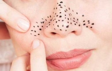 Hilangkan Komedo di Wajah Dengan Cara Ini