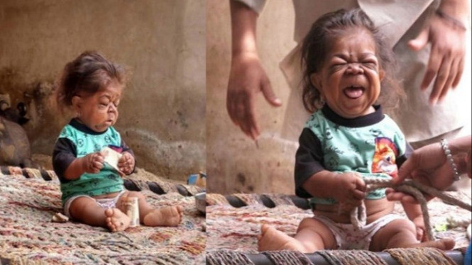 Berusia 23 Tahun, Pria Asal India Ini Punya Tubuh Seperti Bayi